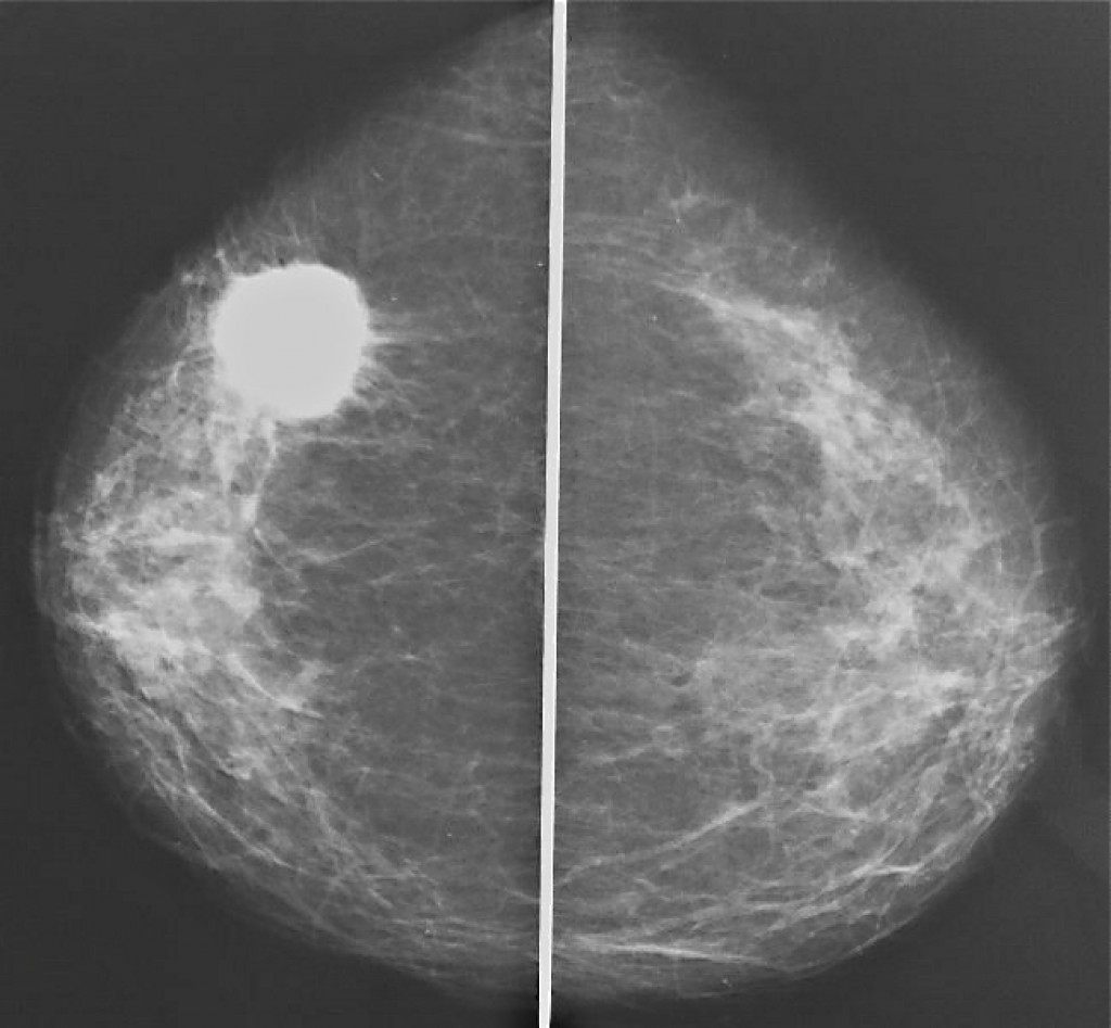 Картина рака на снимках маммографии